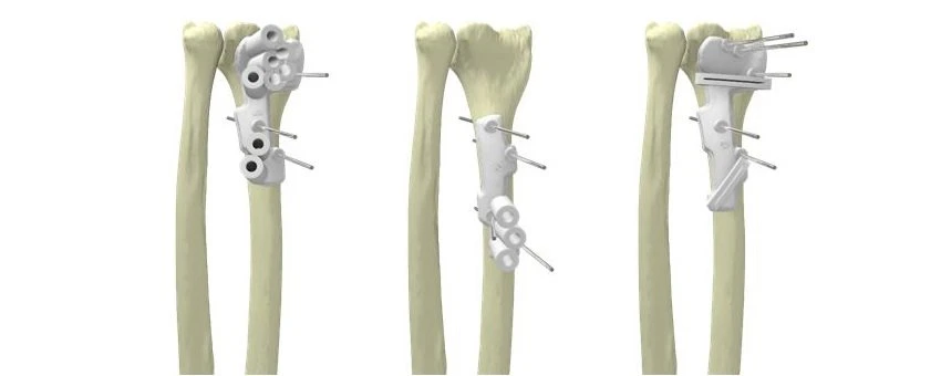3D printing surgical guides